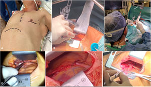 Disección de la AMI bajo visión directa por minitoracotomía izquierda. A) Posición del paciente y localización de la incisión torácica. B) Retractor Thoratrak© para disección de la AMI. C) Retractor Rultrac© (flecha blanca) traccionando de retractor Thoratrak© (flecha roja). D) Visión del cirujano en la disección de la AMII bajo visión directa. E) Detalle de anastomosis en T entre la AMII y la arteria radial. F) Preparación de la AMII izquierda pediculada para anastomosis con la ADA