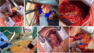 Exposición y estabilización de diferentes vasos coronarios por minitoracotomía izquierda. A) Exposición, estabilización y oclusión coronaria transitoria de la ADA. B) Detalle de anastomosis entre la AMII y la ADA con shunt intracoronario y estabilizador convencional. C) Detalle de anastomosis de la AMII a la ADA y radial en T a diagonal. D) Detalle de Octopus Nuvo© introducido por puerto subxifoideo. E) Exposición y estabilización de ramo marginal del VI con estabilizador percutáneo. F) Exposición y estabilización de ramo bisectriz previo a anastomosis con injerto de vena safena.