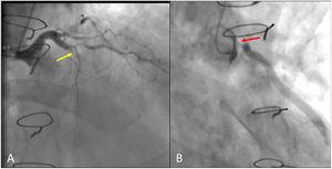 Coronariografía preoperatoria. A) Oclusión crónica de la arteria descendente anterior proximal (flecha amarilla). B) Estenosis crítica ostial de injerto aortocoronario de vena safena (flecha roja). El color de las figuras solo puede apreciarse en la versión electrónica.