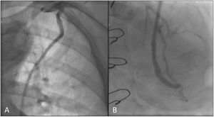 Coronariografía postoperatoria 4 años tras la intervención. A) Anastomosis proximal y trayecto intratorácico del injerto axilocoronario de vena safena. B) Anastomosis distal del injerto de vena safena con la DA distal.