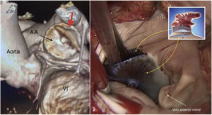 A la izquierda, reconstrucción tridimensional por angio-TAC donde se señala la zona de entrada de contraste dentro de la orejuela (flecha roja). A la derecha, imagen intraoperatoria correspondiente a la misma zona. AA: Amplatzer Amulet; VI: ventrículo izquierdo.