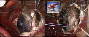 A la izquierda, situación del borde del disco del Amplatzer Amulet que se sitúa justo encima del anillo mitral posterior. En esta misma zona también se observa ausencia de impermeabilidad de la orejuela (a la derecha, flecha roja).