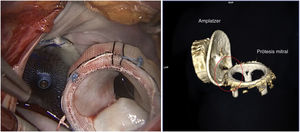 A la izquierda, resultado intraoperatorio. A la derecha, reconstrucción tridimensional por angio-TAC que muestra la relación final del Amplatzer Amulet con la bioprótesis mitral (círculo en rojo).