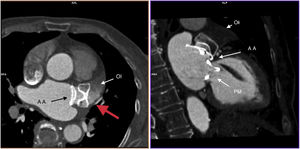 A la izquierda, imagen preoperatoria de angio-TAC con presencia de contraste a través del dispositivo (flecha roja). A la derecha, imagen postoperatoria que confirma impermeabilidad. AA: Amplatzer Amulet; OI: orejuela izquierda; PM: prótesis mitral.