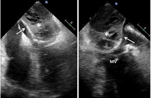 Transesophageal echocardiography (4-chambers and 2-chambers view). The arrows show the limit of atrial wall. *: Left atrial wall dissected with heterogeneous material. MV: mitral valve.