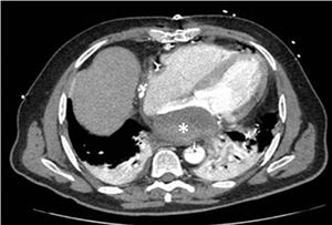 Contrast-enhanced computed tomography. *: Significant occupation of the left atrial cavity by the dissection wall.