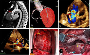 (A) Porcelain aorta, (B) coronary angiotomography, (C) TTE, modified subcostal view, showing massive TR (arrow), (D) reversal flow in inferior vena cava (arrow), (E) heart and cardiac pedicle (arrow), we can observe severe fibrosis an adhesion, (F) tricuspid valve, the anterior and posterior leaflets were thickened and fibrotic.