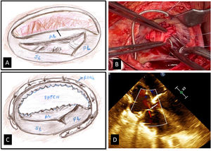(A) Surgical sketch showing the anterior (AL) and posterior leaflets (PL) detached from the annulus (arrow). SL=septal leaflet. (B) Leaflets augmentation. (C) Surgical sketch, complete repair. (D) Postoperative TEE showing adequate coaptation surface (red arrow) and mild TR (white arrow).
