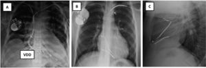 Radiografía de tórax: A) Rx AP: Implante de electrodos de marcapasos de fijación pasiva: 4 electrodos implantados, 2 por subclavia izquierda abandonados y 2 VDD por subclavia derecha, uno abandonado y otro conectado al generador, que está desplazado hacia abajo. VDD: sensores en AD. B y C) Electrodos de DAI implantados por ambas subclavias. B) Rx de tórax AP: Subclavia derecha: 2 electrodos de fijación activa con una angulación de entrada en VCS mucho más aguda que por el lado izquierdo. Por ella entra un electrodo de MP insertado en AD y otro de DAI monobobina en VD. Subclavia izquierda: 2 electrodos de fijación activa cortados y traccionados: el de MP de AD presenta el conductor deshilachado y el de DAI de VD tiene rectificado su trayecto en VD fruto de la tracción sufrida y el estilete de contratracción cortado antes de entrar en subclavia izquierda. C) Rx de tórax lateral: 2 electrodos en AD y 2 electrodos de VD, uno de ellos elongado. AD: aurícula derecha; AP: antero-posterior; DAI: desfibrilador automático implantable; MP: marcapasos; Rx: radiografía; VCS: vena cava superior; VD: ventrículo derecho; VDD: marcapasos VDD.