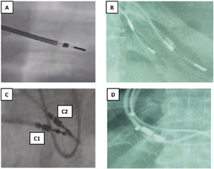 Tipos de fijación a endocardio y sensor de MP VDD. A y B) Electrodos de fijación pasiva con dos estructuras metálicas separadas entre sí 1-1,5cm y entre ellas un fino hilo metálico. C) Electrodos de fijación activa: C1: 2 puntos metálicos pequeños separados al desplegar la hélice de fijación. C2: un solo punto metálico mayor con la hélice plegada. D) Dos puntos metálicos en cada cable correspondiente a los sensores de AD en los MP VDD. AD: aurícula derecha; MP: marcapasos; VDD: marcapasos VDD.