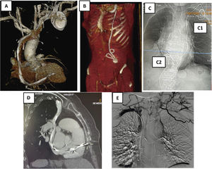 Angio-TAC de tórax. A) Recorrido de los electrodos con zonas de fibrosis en VCS y AD. B) Electrodos tunelizados hasta región periumbilical con bucles y fibrosis. C) Electrodo de MP de fijación pasiva que se implanta en VD. C1) a través de vena cava izquierda y C2) a través de vena femoral derecha. D) Perforación de electrodo de MP de fijación activa en el VD. E) Obstrucción de VCS y desarrollo de gran cantidad de circulación colateral en paciente con restos de múltiples electrodos traccionados y retenidos. AD: aurícula derecha; MP: marcapasos; VCS: vena cava superior; VD: ventrículo derecho.