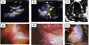 Concordancia ecocardiografía-toracoscopia. A1) ETE: plano BIcava. Paso de electrodo por VCS y presencia de verruga en electrodo auricular (flecha amarilla). A2) toracoscopia: visualización de extremo distal de vaina mecánica por transparencia de la pared de VCS. B1) ETE: tracción de electrodo de VD, con colapso en el ápex del VD (flechas). B2) toracoscopia: visualización de las vainas a través de la pared de VD. C1) ETE: derrame pericárdico. C2) toracoscopia: tinción hemática de pericardio por hemopericárdico. AD: aurícula derecha; ETE: ecocardiografía transesofágica; VD: ventrículo derecho; VSC: vena cava superior.