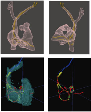 Realidad aumentada. Imágenes en 3D que permiten el análisis del recorrido de electrodos intracardiaco con identificación precisa de bucles, giros y adherencias.