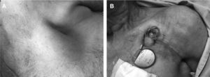 Infección superficial del bolsillo del DEC. A) Decúbito de bolsillo de marcapasos con erosión de la piel. B) Extrusión de generador y segmento subcutáneo de cable con exudado purulento. El frotis del exudado purulento fue positivo para Pseudomonas aeruginosa.