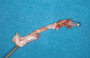 Extracción de la porción intracardiaca de cable de DEC, con signos macroscópicos de formación de biofilm cuyo cultivo fue positivo para Staphylococcus epidermidis.