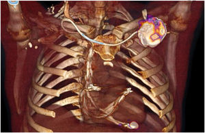 Reconstrucción en 3D de la [18F]FDG-PET/TC que muestra captación patológica del radio trazador en el bolsillo del DEC y en el extremo distal del trayecto intracardiaco del cable.