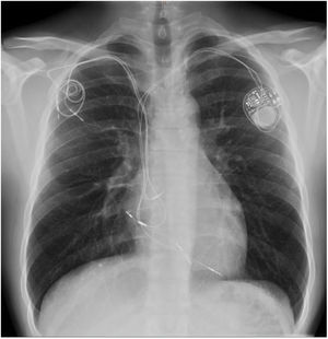 Radiografía de tórax posteroanterior donde se observan todos los electrodos previamente implantados en el paciente.