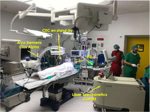 Disposición en quirófano del equipamiento aconsejable para la realización de un procedimiento de extracción de electrodos cardíacos mediante vaina láser excimer.