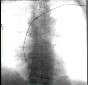 La vaina láser debe ser mantenida siempre recta en dirección coaxial al electrodo, con el extremo distal biselado de la vaina orientado hacia la curvatura interior de la vena cava superior.