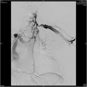Flebografía preoperatoria que muestra oclusión completa crónica de la vena innominada con el desarrollo de abundante circulación colateral en paciente portador de DAI bicameral bibobina.