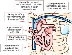 Principales complicaciones cardiovasculares que se pueden producir durante la extracción de electrodos de DEIC con vaina láser excimer.