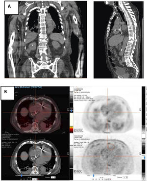 PET-TAC. A) Espondilodiscitis D11-12 en corte coronal y sagital. B) Actividad metabólica en extremo distal electrodo en septo interauricular.