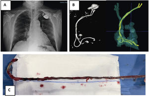 Electrodos torsionados. A) Radiografía de tórax con implante de 3 electrodos de MP por subclavia izquierda. B) Reconstrucción con TAC y realidad aumentada donde se observa torsión entre electrodos. C) Extracción conjunta de los 3 cables que están enrollados. MP: marcapasos; RX: radiografía; TAC: tomografía axial computerizada.