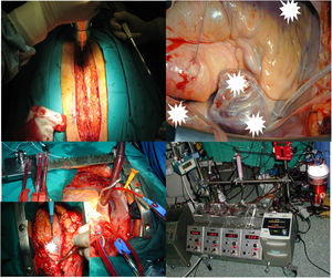 Cardiocirugía de rescate bajo circulación extracorpórea.