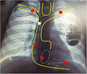 Representación esquemática del sistema vascular venoso superior sobre radiografía de tórax de la aurícula derecha, válvula tricúspide y ventrículo derecho. Los puntos rojos evidencian los sectores del sistema cardiovascular con mayor riesgo potencial de complicación mayor por rotura. El punto blanco señala la porción distal de la vena cava superior adyacente a su conexión con el tronco venoso innominado (segmento de mayor riesgo de rotura durante un procedimiento de extracción). VT: representación esquemática de la válvula tricúspide.