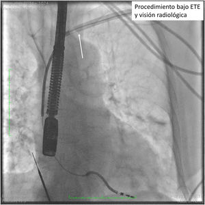 Visión radioscópica de un procedimiento de extracción de electrodo de desfibrilación de doble coil. La flecha blanca indica el límite de la vaina externa de contratracción.