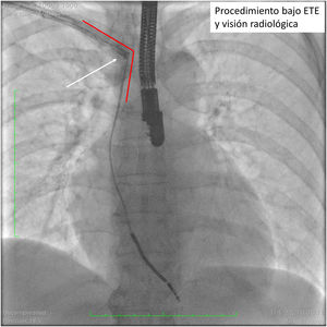 Visión radioscópica de un procedimiento de extracción de un electrodo de desfibrilación mono-coil. La flecha blanca muestra la deformación del sistema vascular venoso por empuje excesivo, forzando un ángulo en el que la vaina de extracción presiona sobre la pared venosa con el potencial riesgo de rotura.