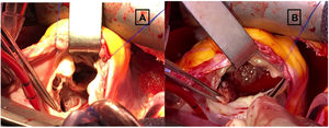 Imágenes intraoperatorias tomadas desde la posición del cirujano principal, de la reparación completa de una adulta con situación Fallot del tipo ventrículo derecho de doble cámara y comunicación interventricular (CIV). Se ha realizado una atriotomía derecha, y la visión de las estructuras es a través de la válvula tricúspide. A. CIV bajo los velos tricuspídeos septal y anterior, y en plano superior las bandas hipertróficas en la salida del ventrículo derecho. B. Infundíbulo del ventrículo derecho tras seccionar las bandas hipertróficas.