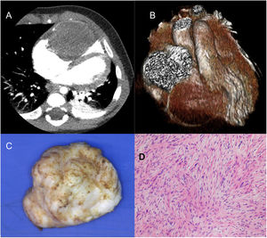 Lactante mujer de 5 meses y 9kg con fibroma gigante en ventrículo derecho (46×36×27mm). Corte transversal (A) y reconstrucción tridimensional (B) de tomografía computarizada cardiaca. Imagen macroscópica (C) nacarada del fibroma explantado en su totalidad. Imagen microscópica (D) con hematoxilina-eosina donde se observan fibroblastos en una densa matriz de colágeno y elastina compatibles con fibroma.