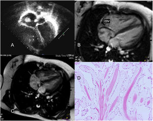 Niña de 13 años y 50kg operada de Fallot a los 5 meses. Diagnóstico en seguimiento ecocardiográfico (A), plano apical de 4 cámaras de masa hiperecogénica redondeada localizada en región posterior de la aurícula derecha. Cortes transversales de resonancia magnética donde observamos: flujo de comunicación interventricular (CIV) residual tipo Gerbode (B) y, señalada con flechas, la masa en aurícula derecha (C). Imagen microscópica (D) con hematoxilina-eosina del tumor constituido por papilas avasculares y mixoides revestidas por células endoteliales, compatible con fibroelastoma papilar.