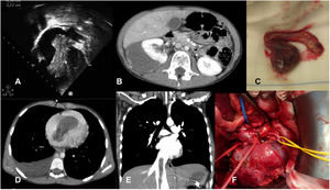 Niña de 10 años y 24kg que acude a Urgencias por disnea. Imagen ecocardiográfica (A) en plano apical de 4 cámaras donde se observa gran masa de 20×65mm que entra en la aurícula derecha desde la vena cava inferior e invade hasta el ventrículo derecho. B, D y E son imágenes de la angio-TC toracoabdominal donde se observa una gran masa abdominal dependiente del riñón derecho compatible con tumor de Wilms (B), que invade el corazón (D) a través de la vena cava inferior (E). Imágenes intraoperatorias de la disección del riñón derecho con el tumor adherido a su polo superior (F), y masa intracardiaca con la extensión desde la vena cava inferior explantadas (C).