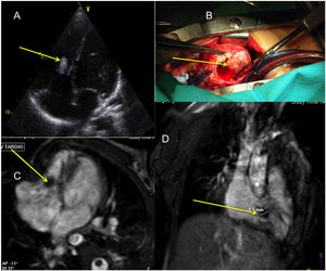 Imágenes diagnósticas de niña de 3 años con trombo en la válvula tricúspide señalado con una flecha amarilla. A: plano ecocardiográfico de 4 cámaras. C y D: imágenes de resonancia magnética transversal y sagital, respectivamente. B: imagen intraoperatoria con abordaje desde atriotomía derecha longitudinal, observándose el trombo adherido al velo anterior tricuspídeo.