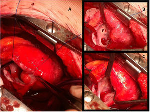 Imágenes intraoperatorias de la niña con el fibroelastoma papilar comentada en la figura 2. Tras atriotomía derecha longitudinal, el tumor de 2cm se ve adherido a la pared anterior de la aurícula derecha (A). En la imagen B se observa el Gerbode residual señalado con una flecha, y en C el mismo defecto cerrado con parche de pericardio heterólogo.