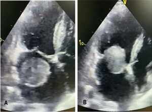 Ecocardiograma transtorácico. Ventana apical cuatro cámaras. A) Tumor ubicado en aurícula izquierda. B) Tumor que protruye hacia el ventrículo izquierdo (diástole).