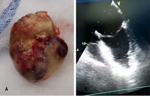 A) Pieza quirúrgica; tumor auricular izquierdo. Peso: 53,3 g. B) Ecocardiografía transtorácica postoperatoria.