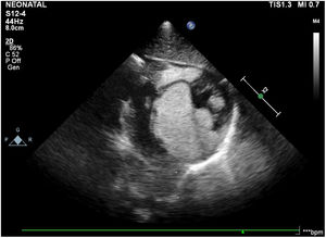 Transthoracic echocardiography demonstrated multiple rhabdomyomas with diameters ranging from 3mm to 26mm in both the right and left ventricles, causing RVOT obstruction, in case 8.
