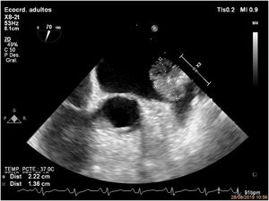Transthoracic echocardiogram revealing a mobile, echogenic, pedunculated mass (22mm×14mm). Speckled appearance, stippled pattern near the edges, with hypoechogenic areas, adhered to the ligament of Marshall.