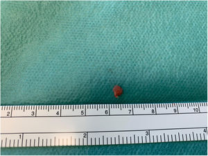 Macroscopic appearance of the mass after surgical excision.