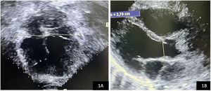 A. Vista de las 4 cámaras donde se observa la membrana dividiendo la aurícula izquierda en 2 cámaras. B. Eje largo en el cual se observa la membrana fibromuscular que se encuentra por arriba de la válvula mitral.