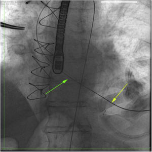 La fluoroscopia muestra como la guía cruza correctamente la válvula aórtica a través del acceso transapical. Sin embargo, la trayectoria de la guía en el ventrículo izquierdo se aprecia curva, como una «comba», fijada en dos puntos concretos: en el punto de acceso transapical (flecha amarilla) y el aparato subvalvular mitral (flecha verde).