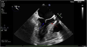 Las imágenes del ETE muestran el thetering del VAM (flecha azul) producido por la guía de alto soporte (flecha roja) que provoca una falta total de coaptación sistólica. Nótese que, en sístole, el velo posterior mitral (VPM) alcanza el plano anular, mientras que el VAM queda notoriamente alejado del mismo.