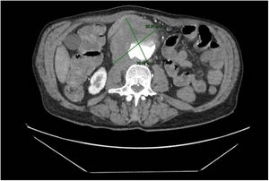 Imagen radiológica del aneurisma con rarefacción de la grasa periaórtica.