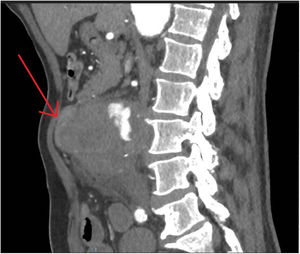 Corte longitudinal de angio-TC en la que se observa aneurisma protruyendo en asas intestinales y pared anterior abdominal.