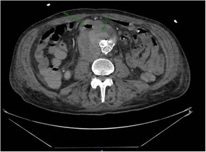 Imagen radiológica posterior al implante de endoprótesis donde se observa zona aérea en contacto con saco aneurismático con posible solución de continuidad.