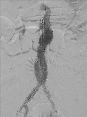 Arteriografía de control tras implante sin endofuga.