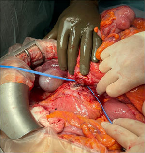 Imagen de cirugía abierta abdominal en la que se observa la fístula diferenciada mediante vessel-loop.